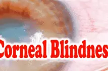 Corneal Blindness