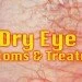 Dry Eye Symptoms & Treatment